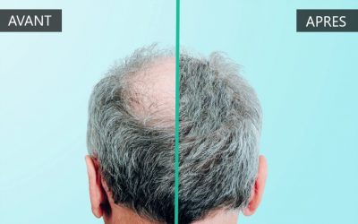 Greffe de cheveux en Hongrie : quels sont les avantages ?