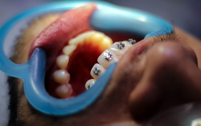 L’importance de l’orthodontie : de la correction de l’alignement à l’amélioration de la santé bucco-dentaire
